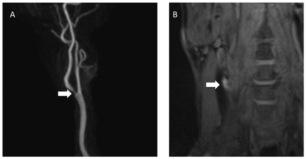 Carotid bulb stenosis