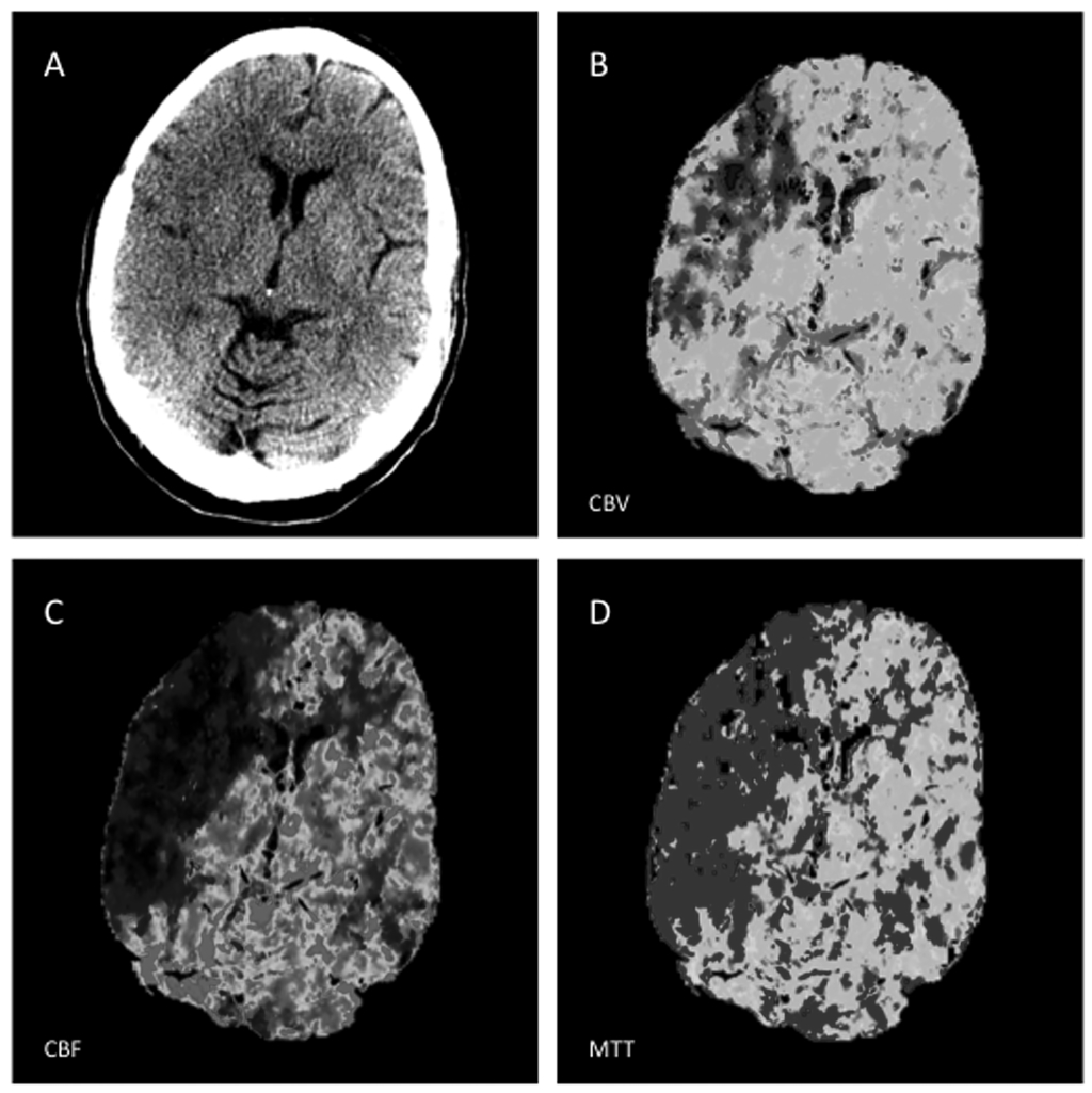 Large Matched MCA Core Infarction