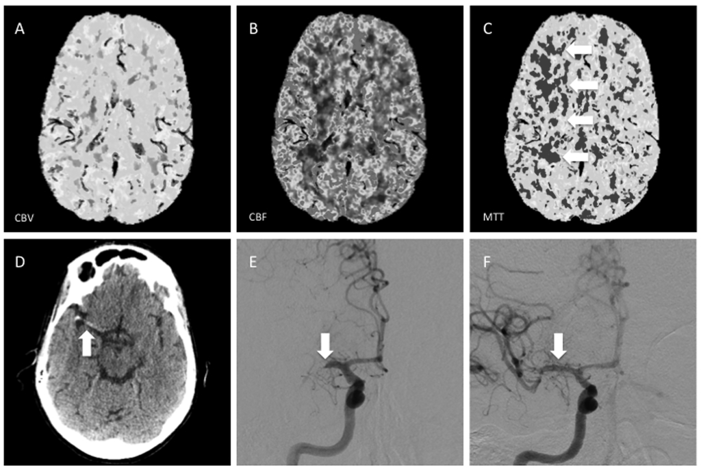Large Penumbra on CT Perfusion