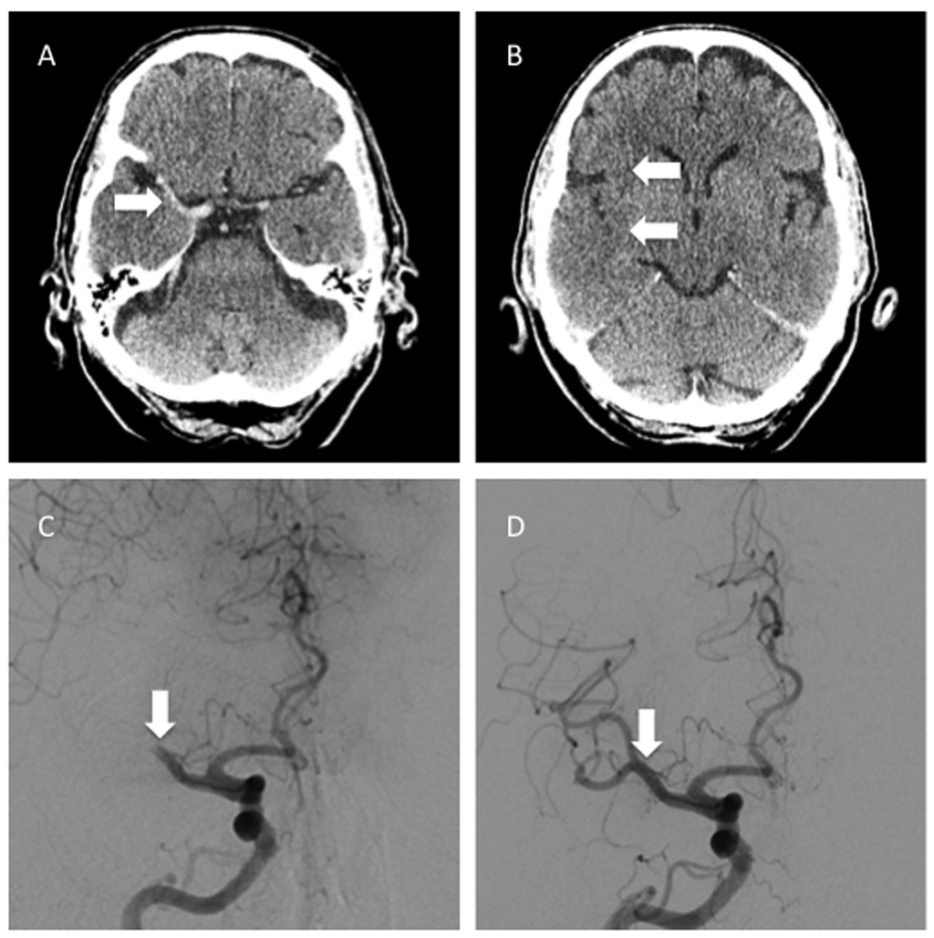MCA recanalization with stent retriever