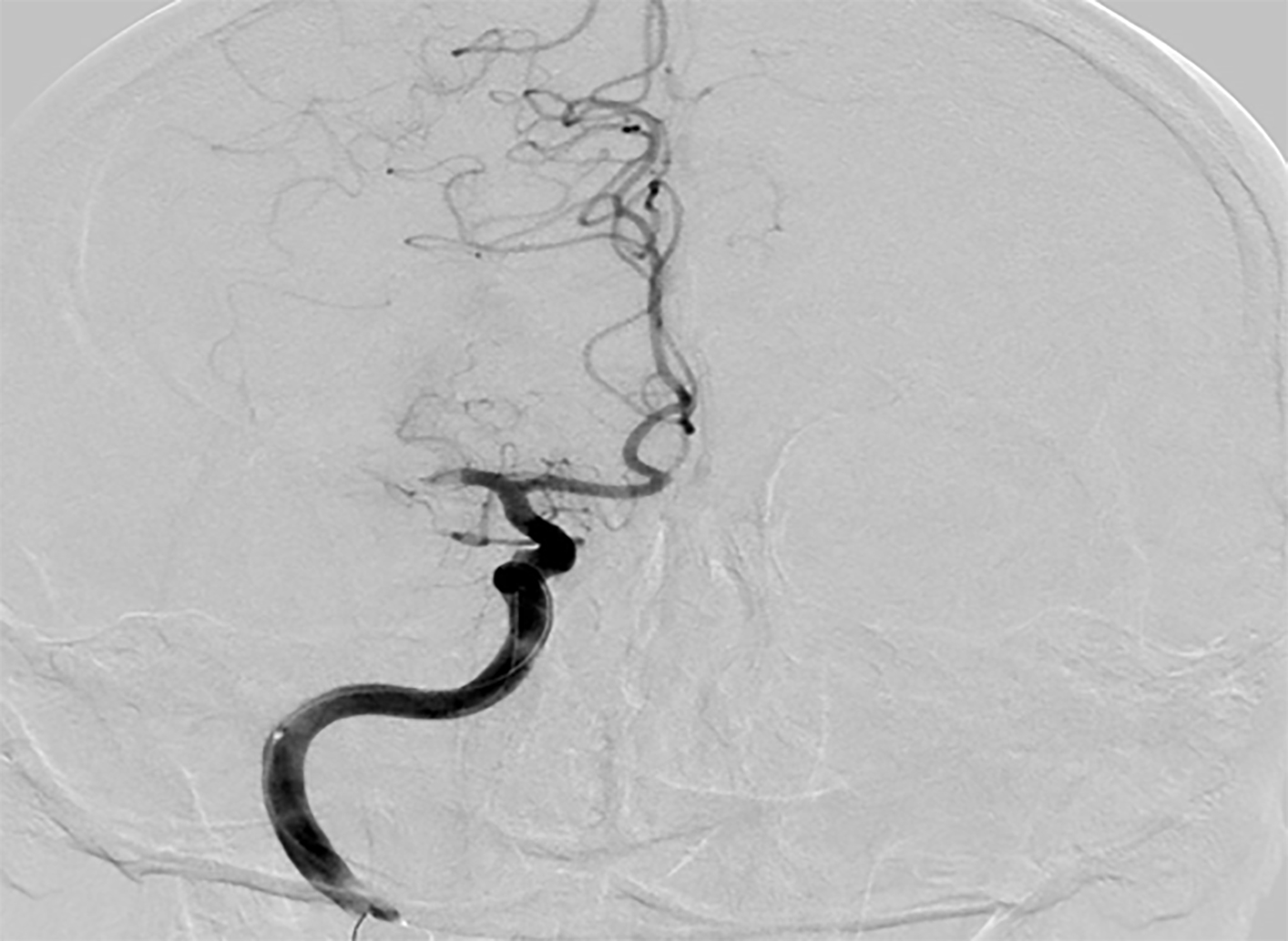 Occlusion of right middle cerebral artery