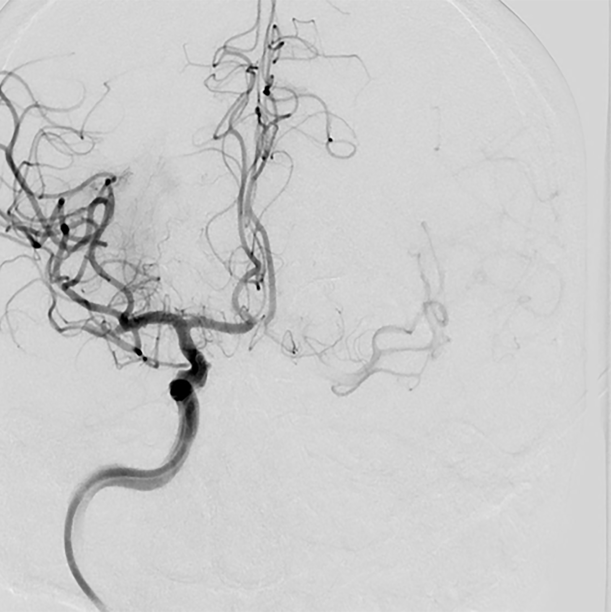 Revascularization of right middle cerebral artery