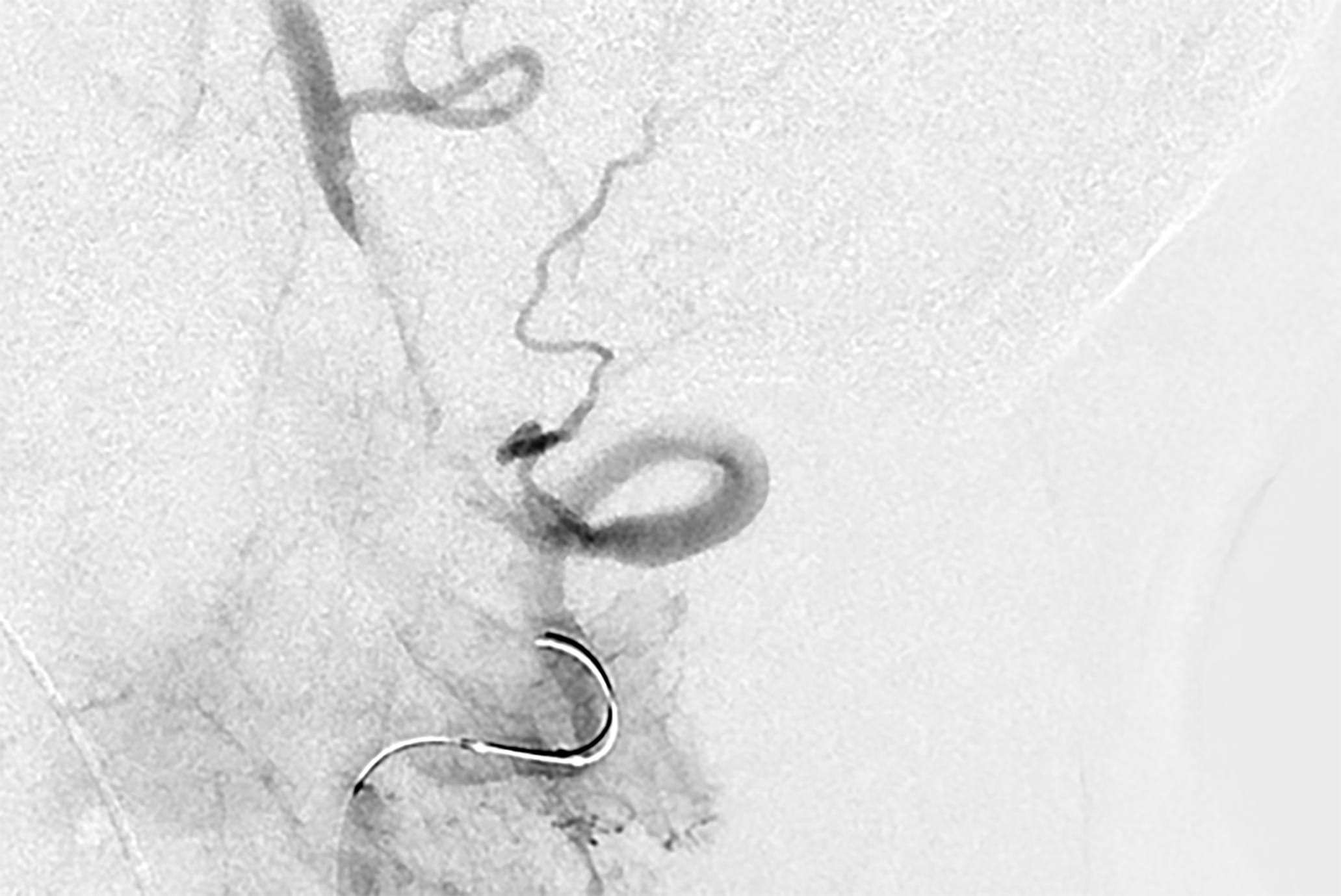 Occlusion of proximal basilar artery