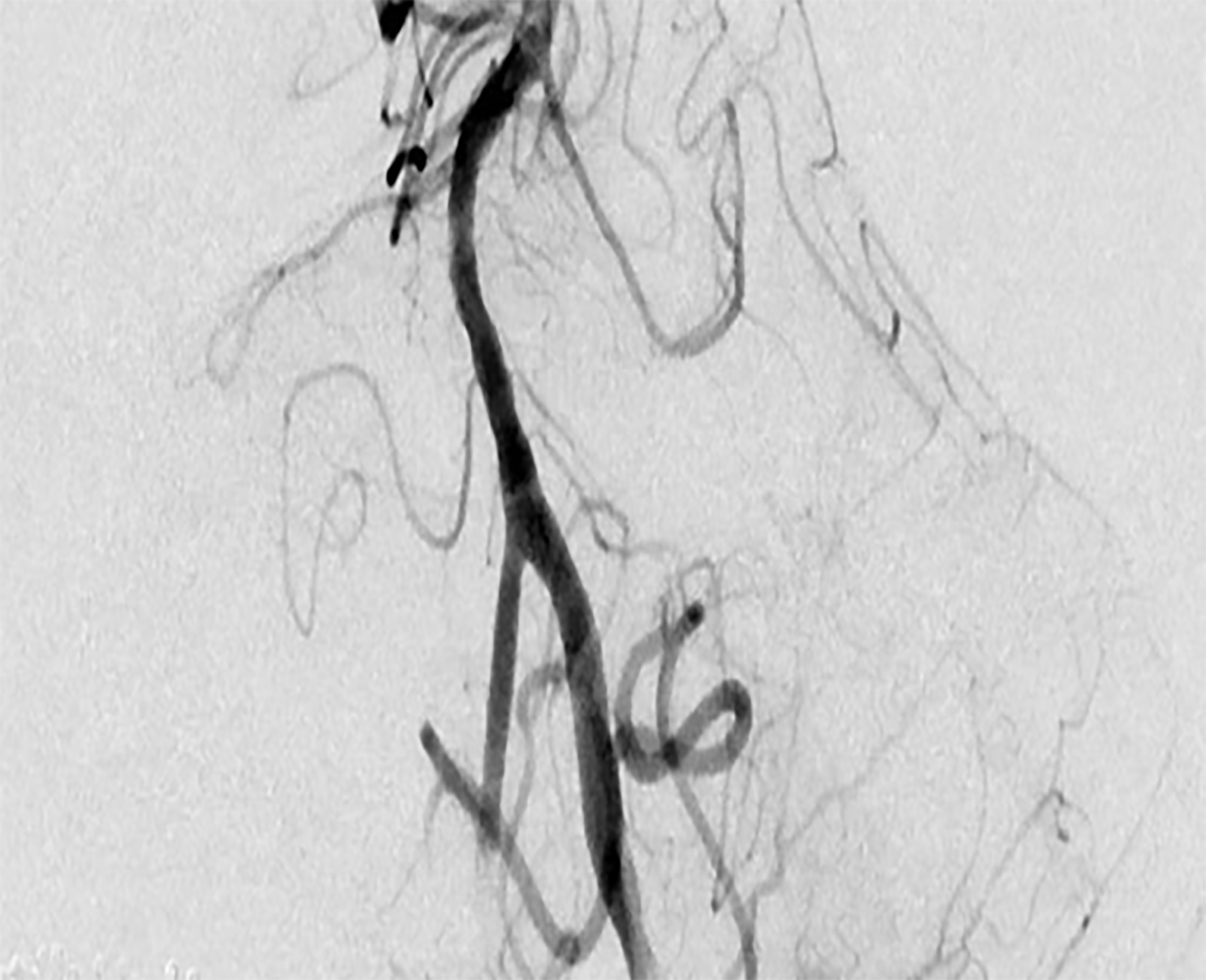 Revascularization of proximal basilar artery