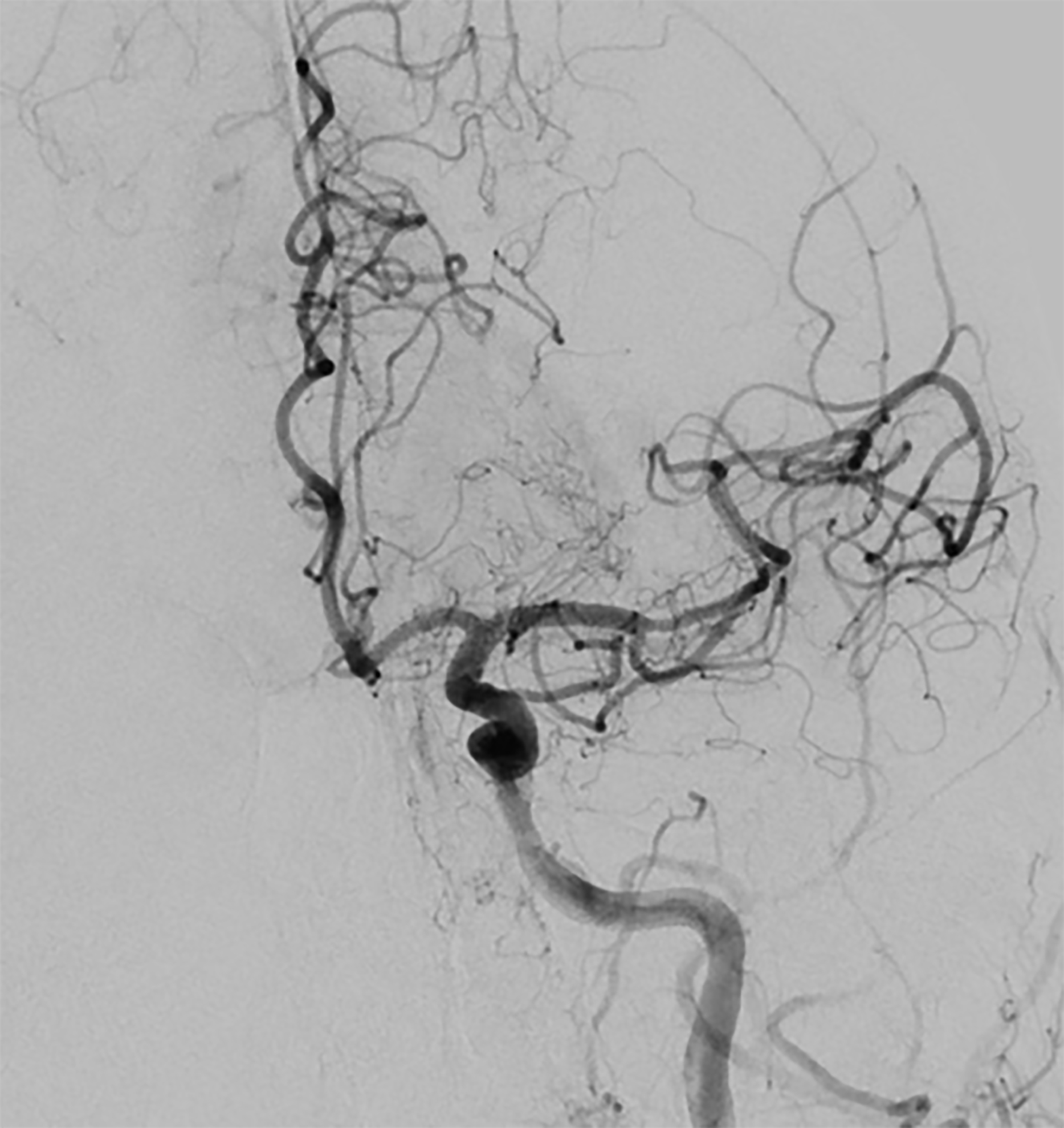Revascularization of left middle cerebral artery