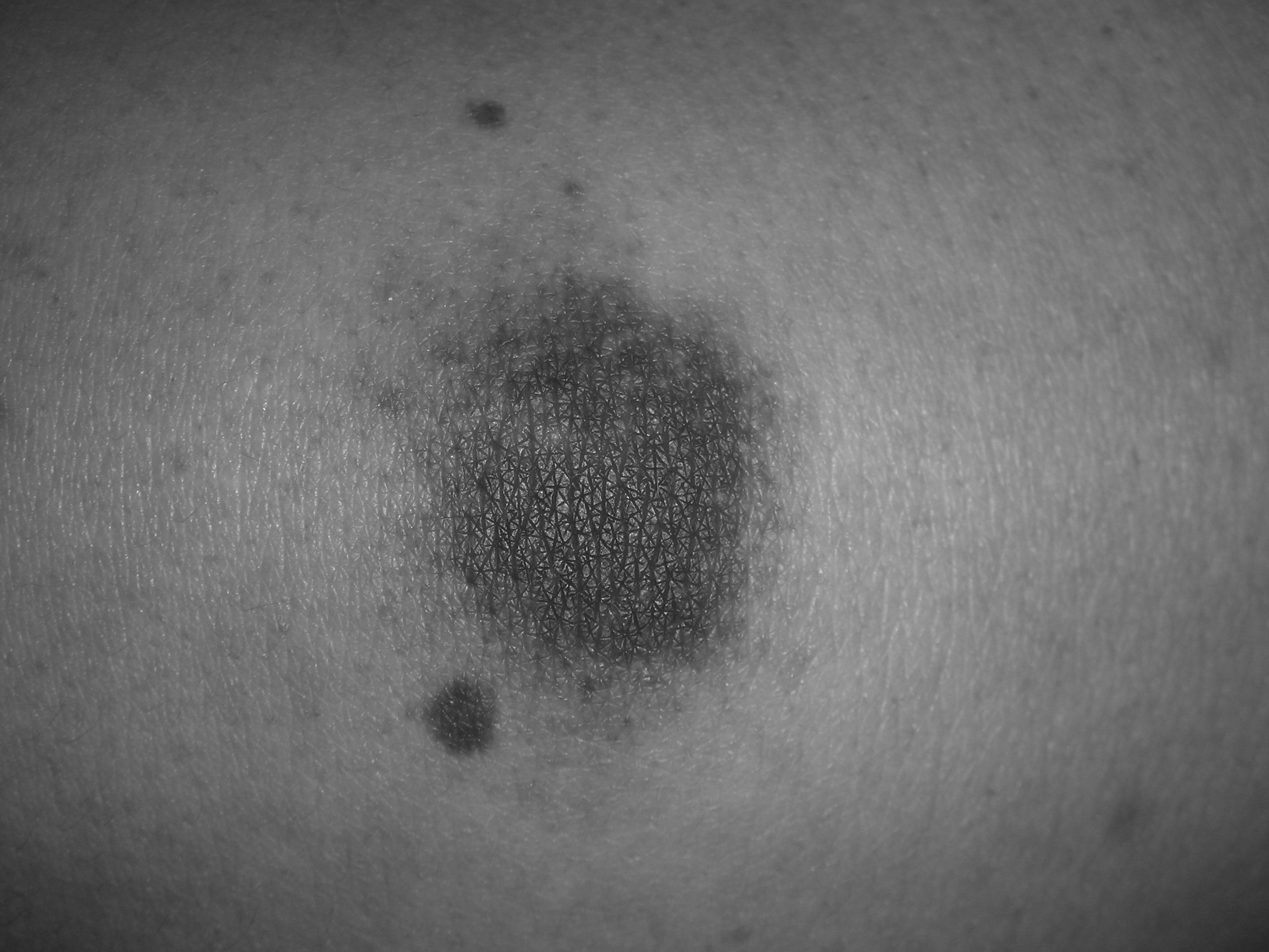 Petechiae