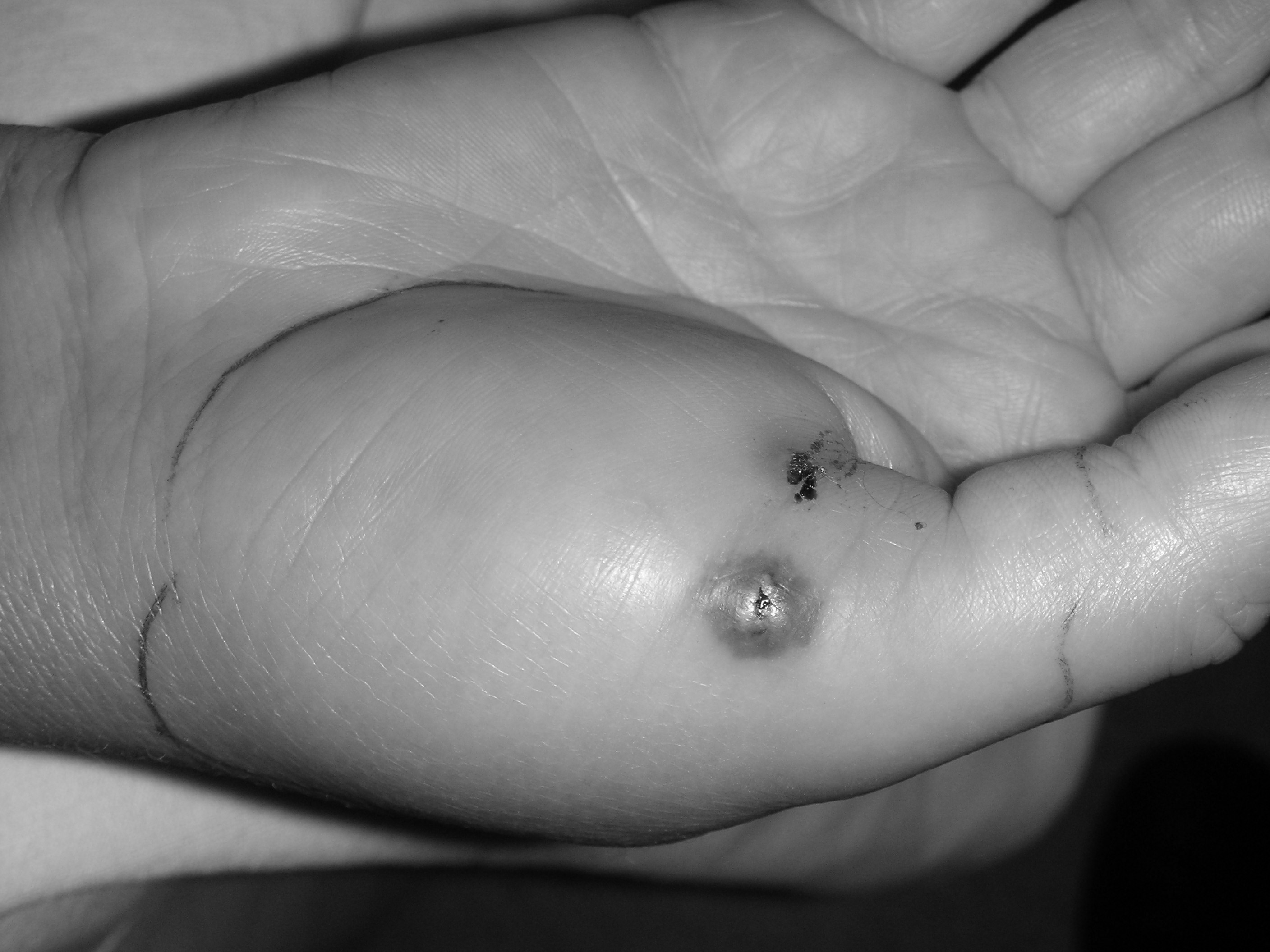 Hand Infection Due to Cat Bite