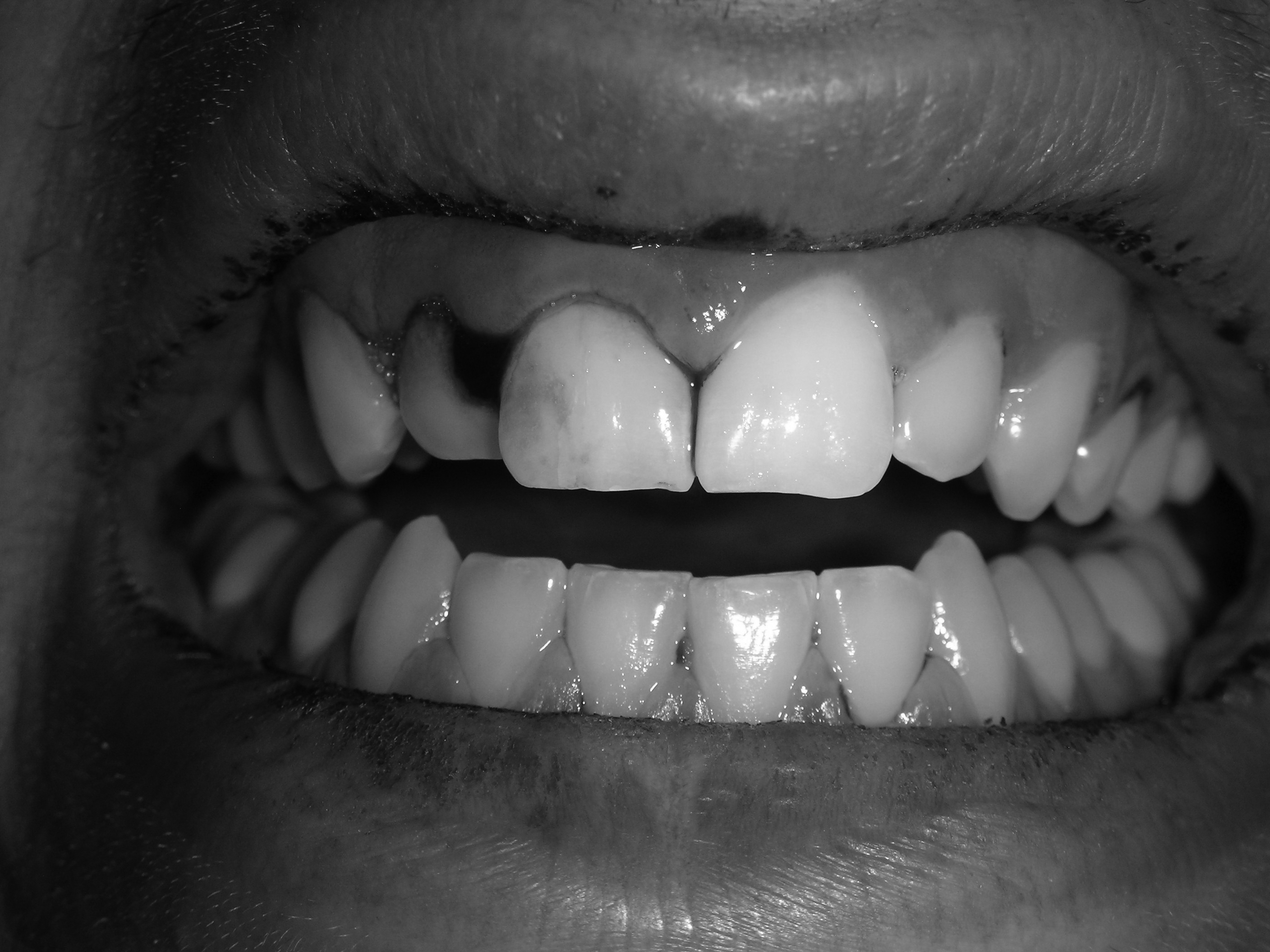 Gingival hemorrhage