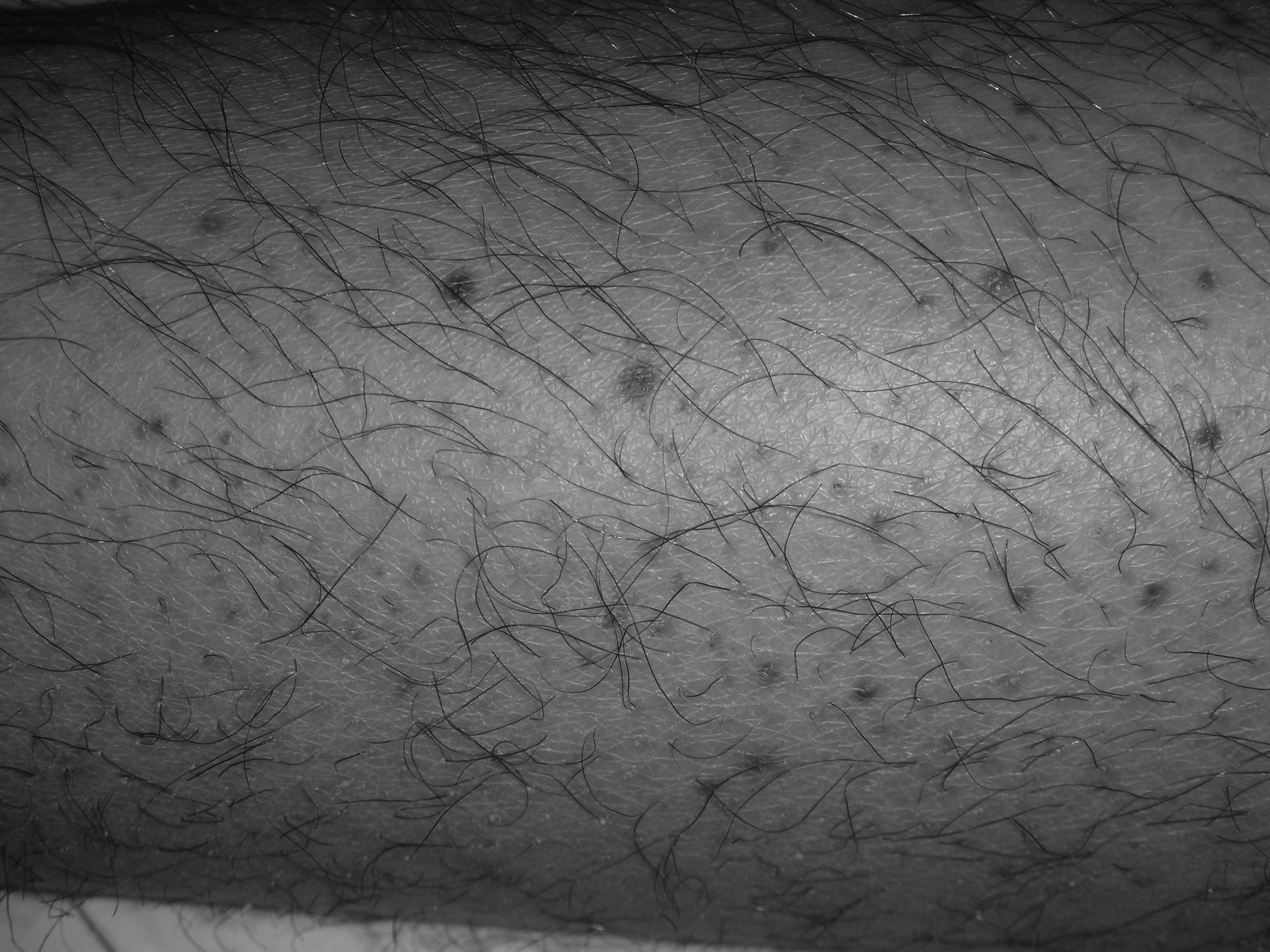 Petechiae
