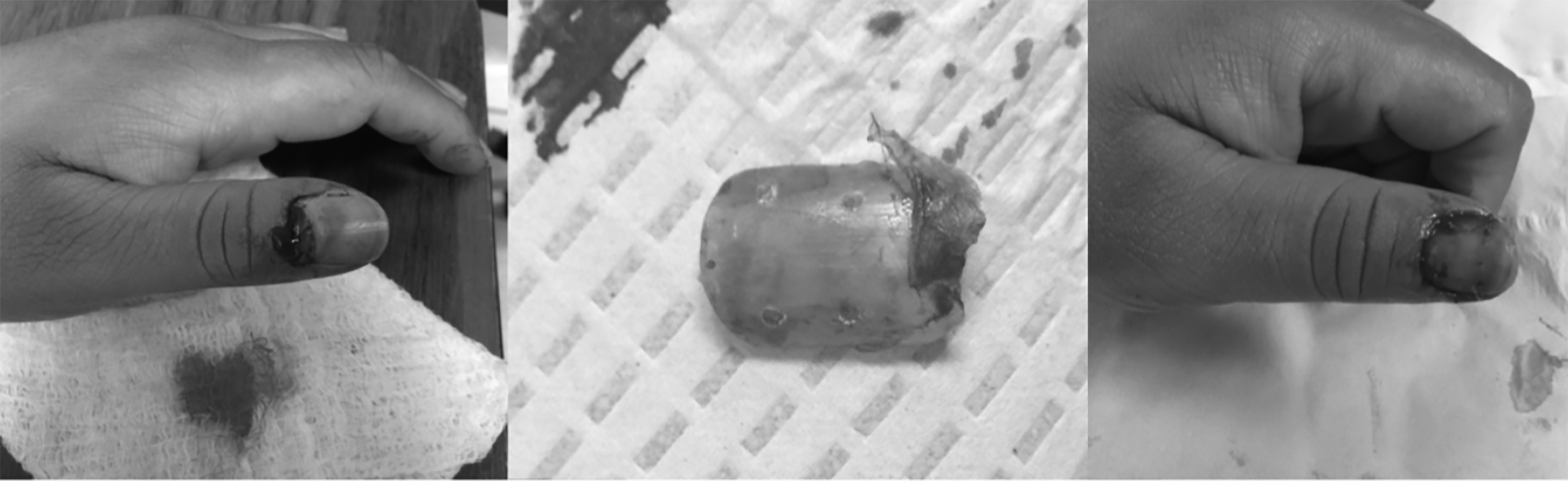 Nail bed laceration