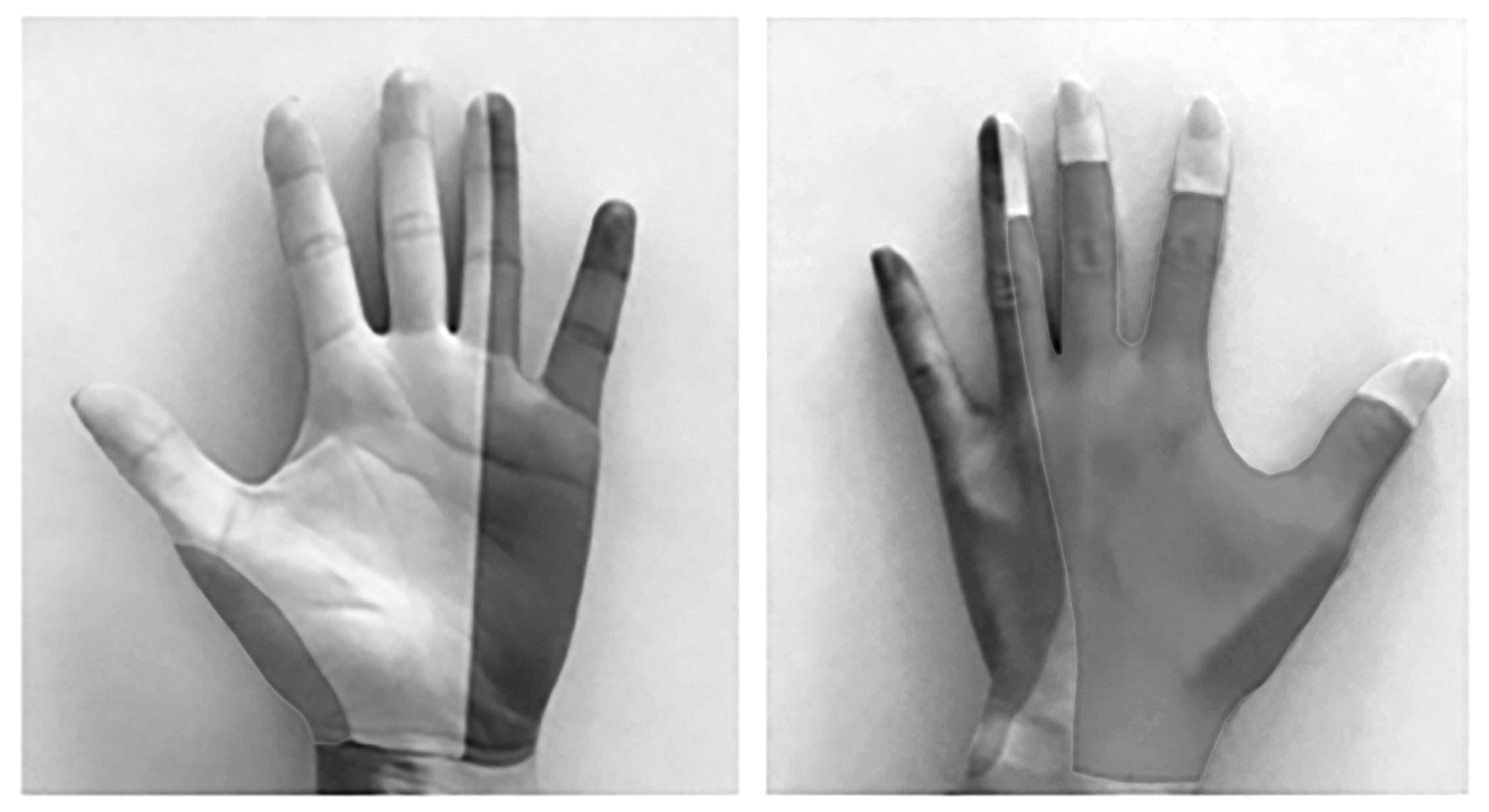 Sensory distributions of nerves in the hand