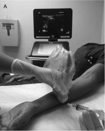 Radial nerve block