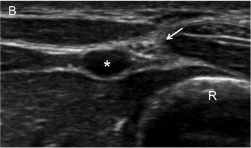 Radial nerve block