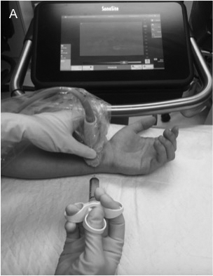 Ulnar nerve block