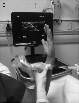 Ulnar nerve block