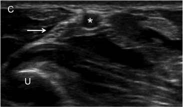 Ulnar nerve block