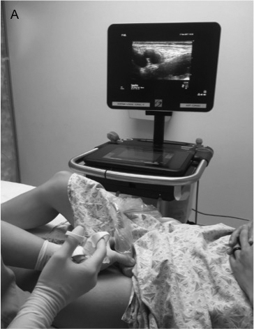 Femoral nerve block