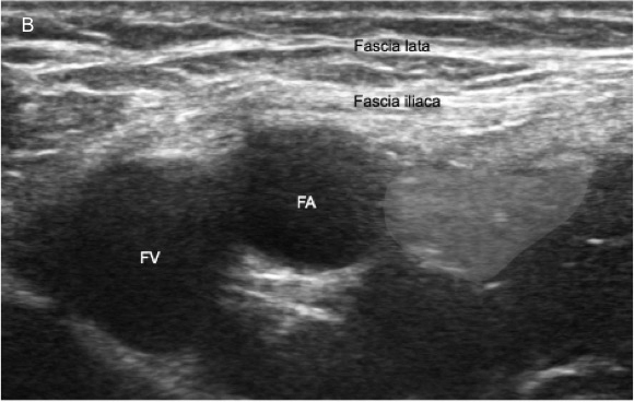 Femoral nerve block