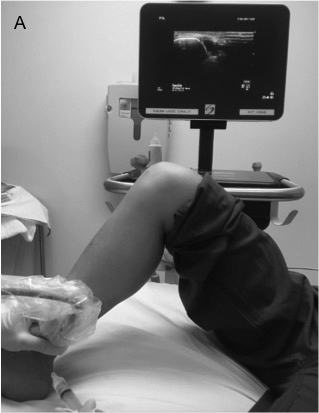 Posterior tibial nerve block