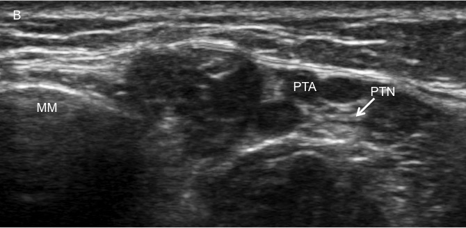Posterior tibial nerve block