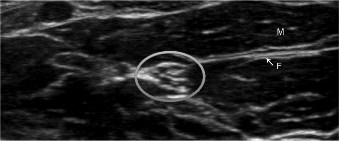 Nerve appearance