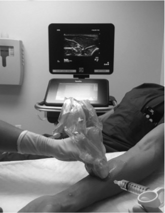 Median nerve block