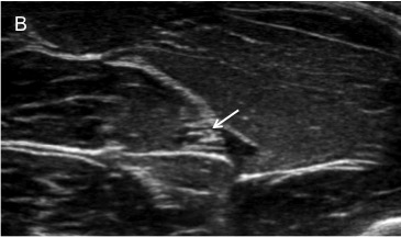 Median nerve block