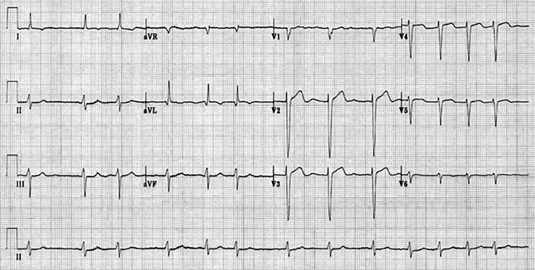 Atrial fibrillation with fine waves