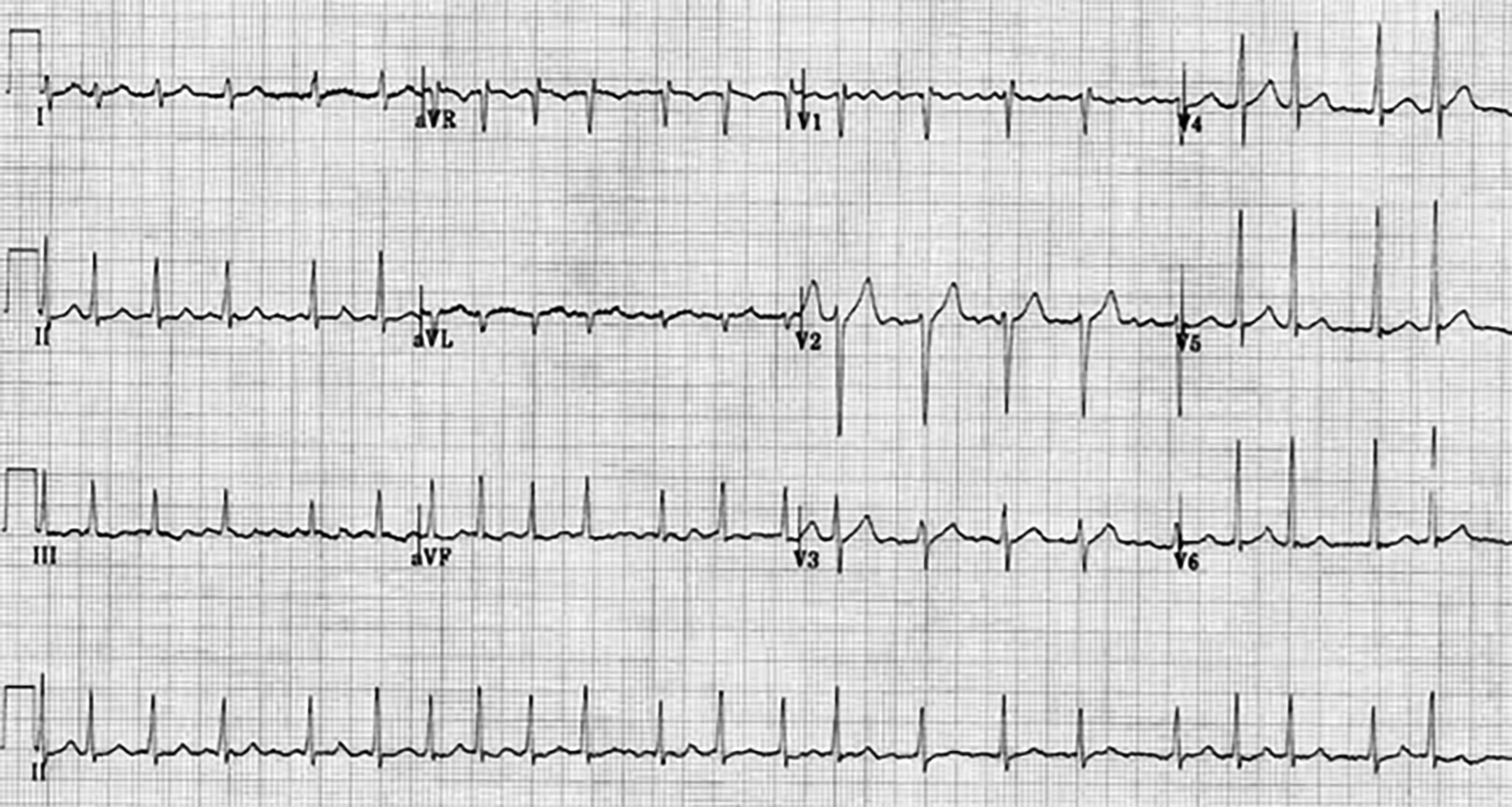 Atrial fibrillation rapid ventricular response