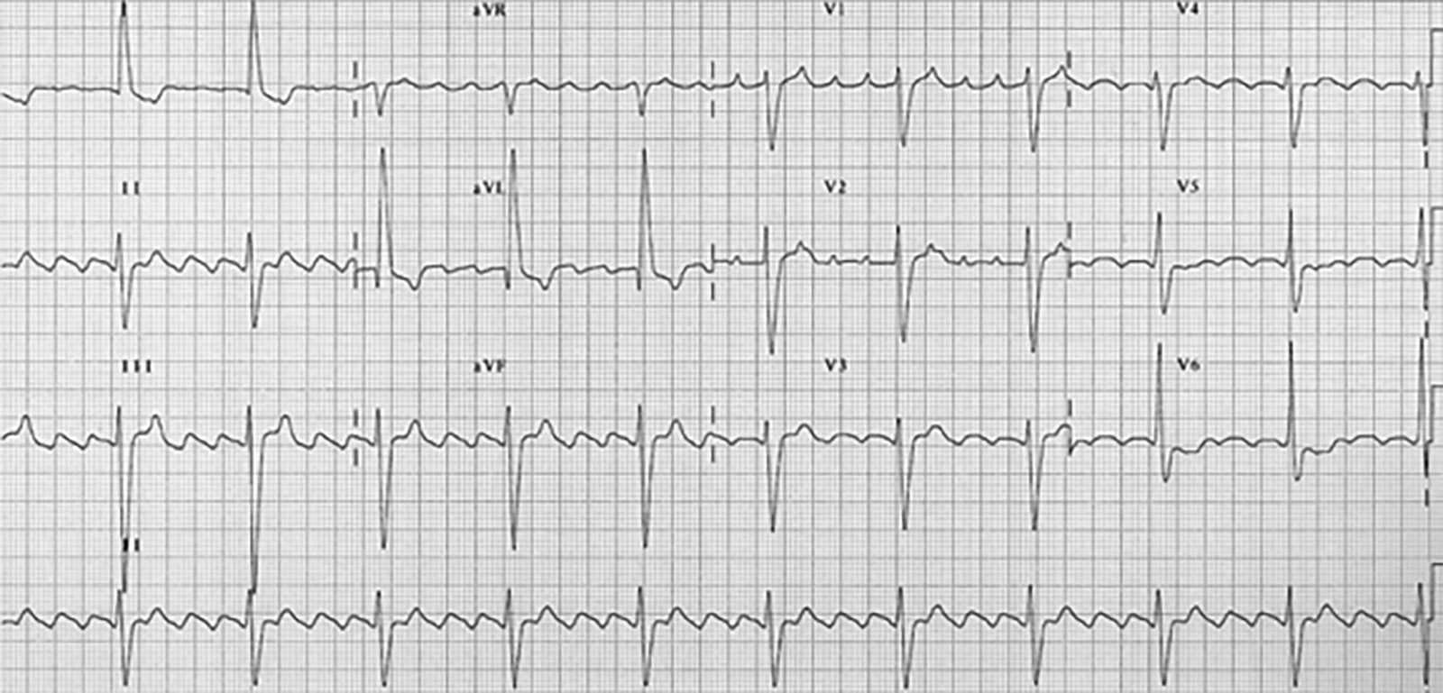 Atrial flutter