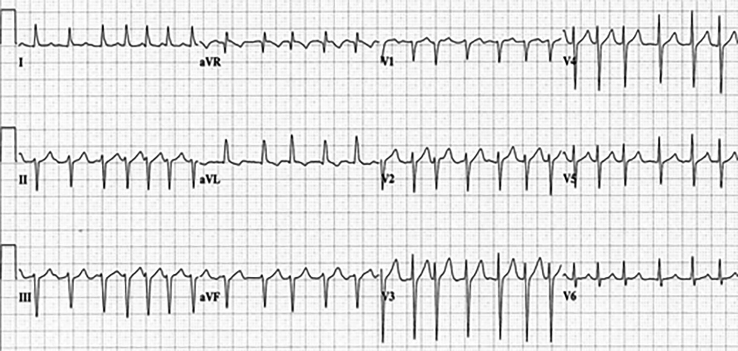 Case 2 ECG
