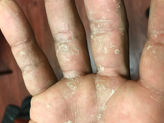 Tinea manuum