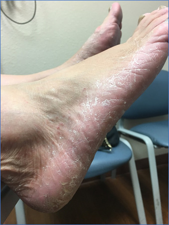Tinea pedis