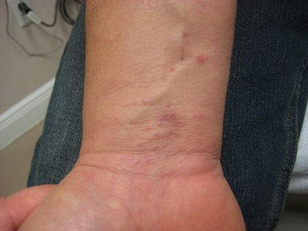 Lichen planus