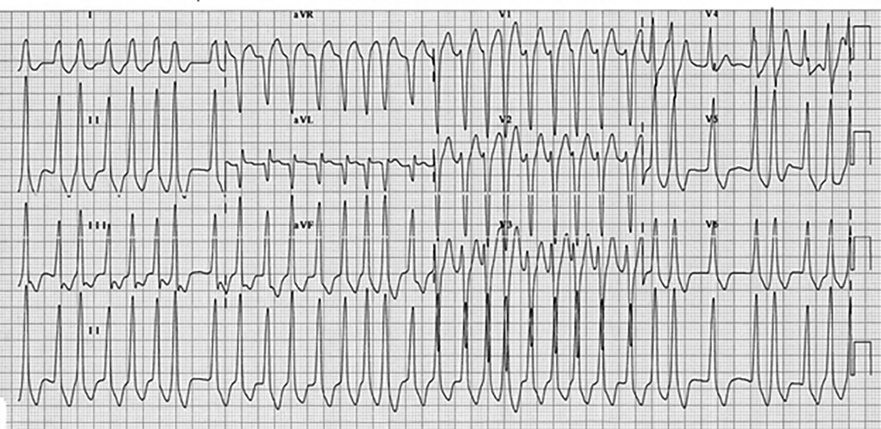 Wolff-Parkinson-White syndrome