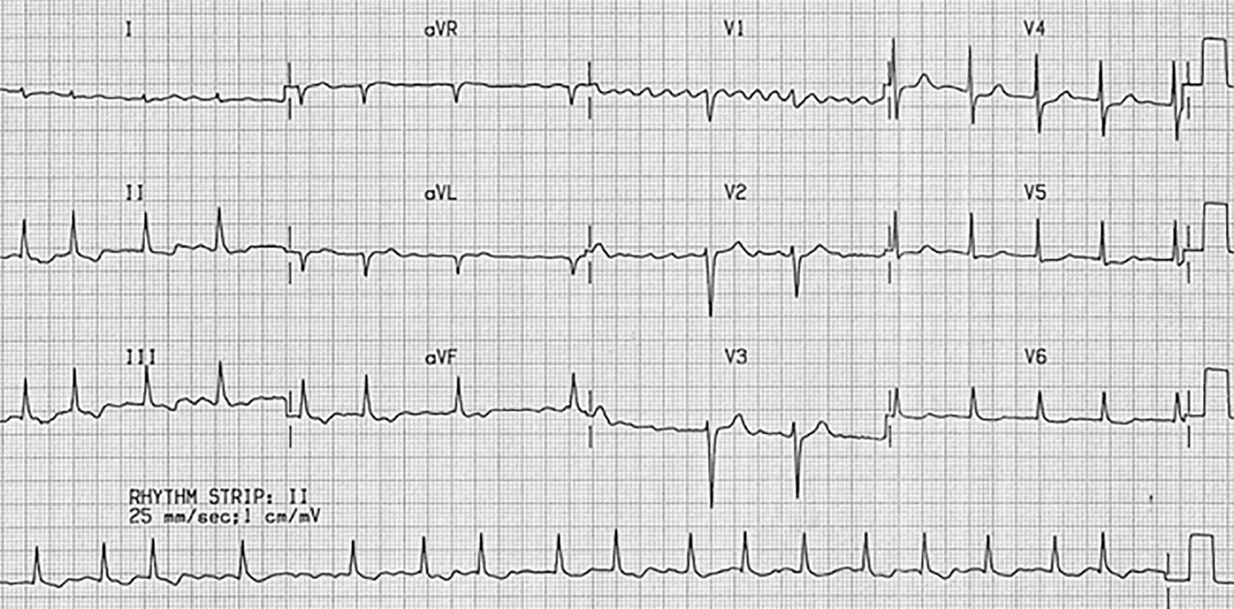 Atrial fibrillation coarse waves