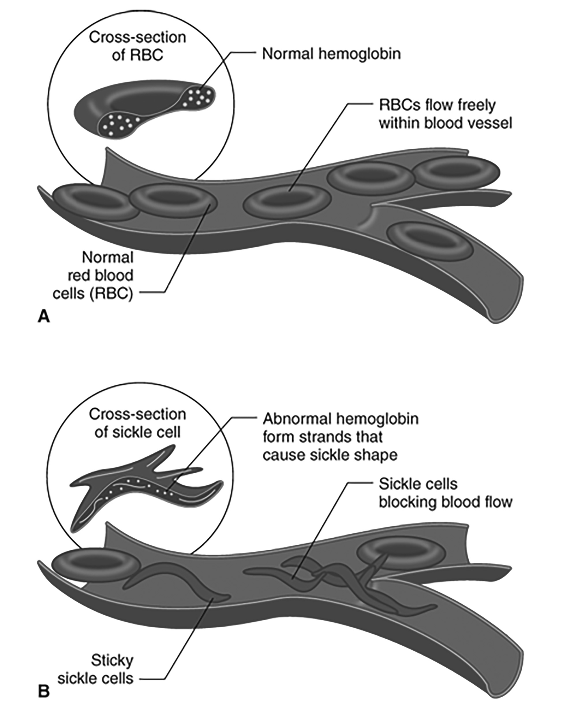 Normal red blood cell vs. sickle cell