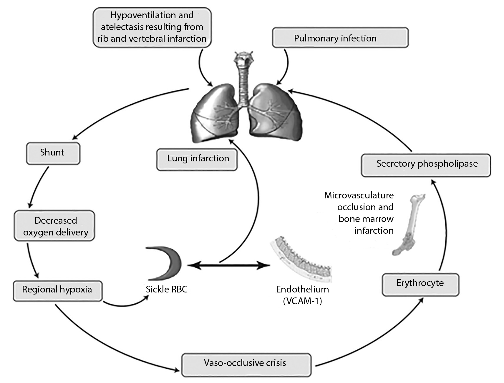 Acute Chest Syndrome