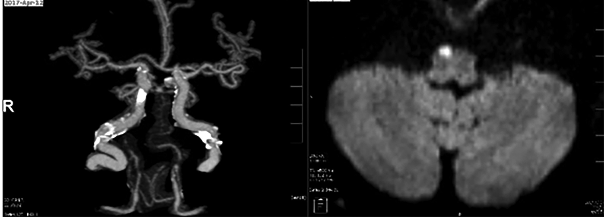 CTA and MRI