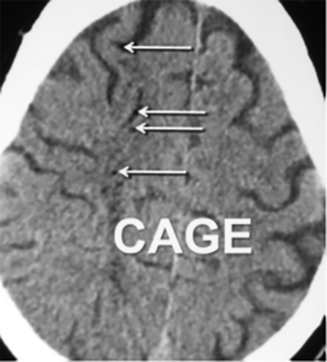 Bubbles in cerebral vasculature