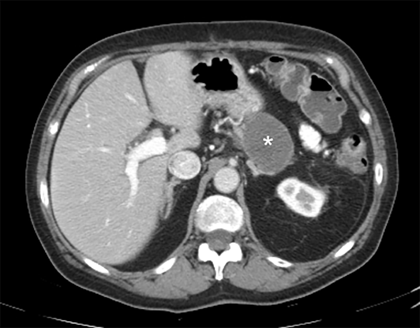 Computed Tomography Demonstrating a Pseudocyst
