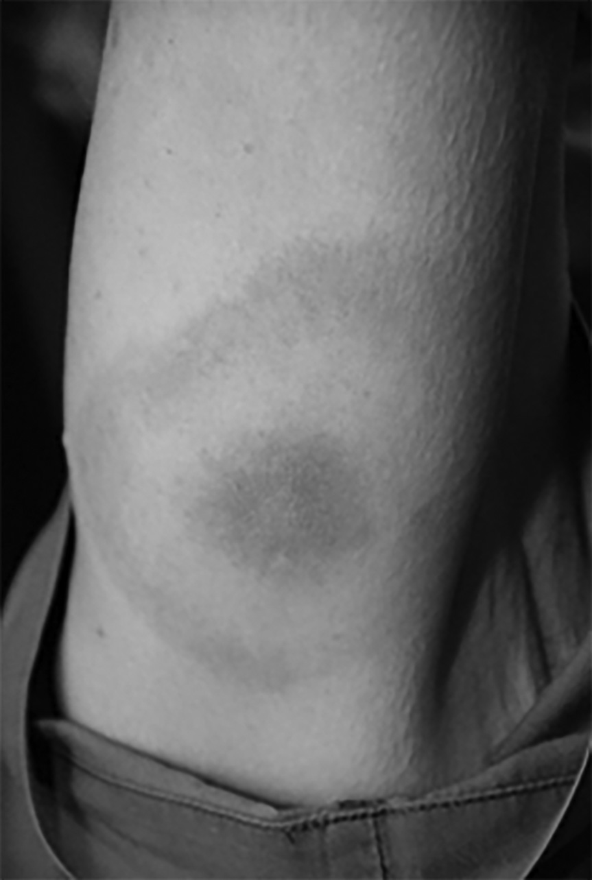 Bull's eye rash