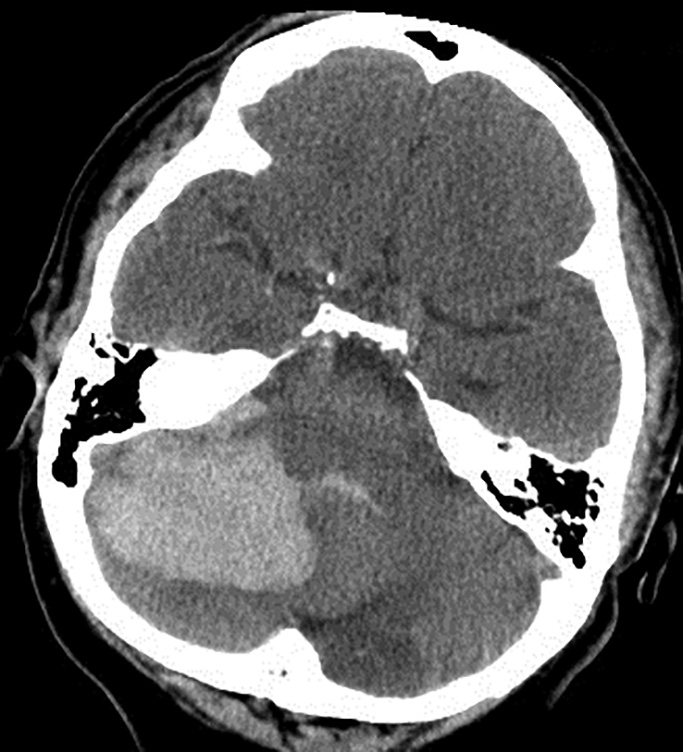 Cerebellar hemorrhage