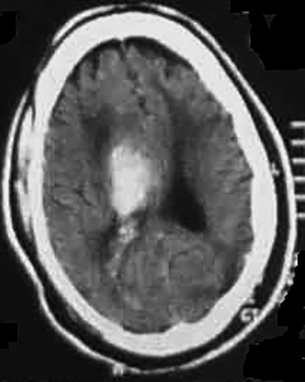 Basal ganglia hemorrhage