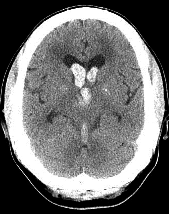 Intraventricular hemorrhage