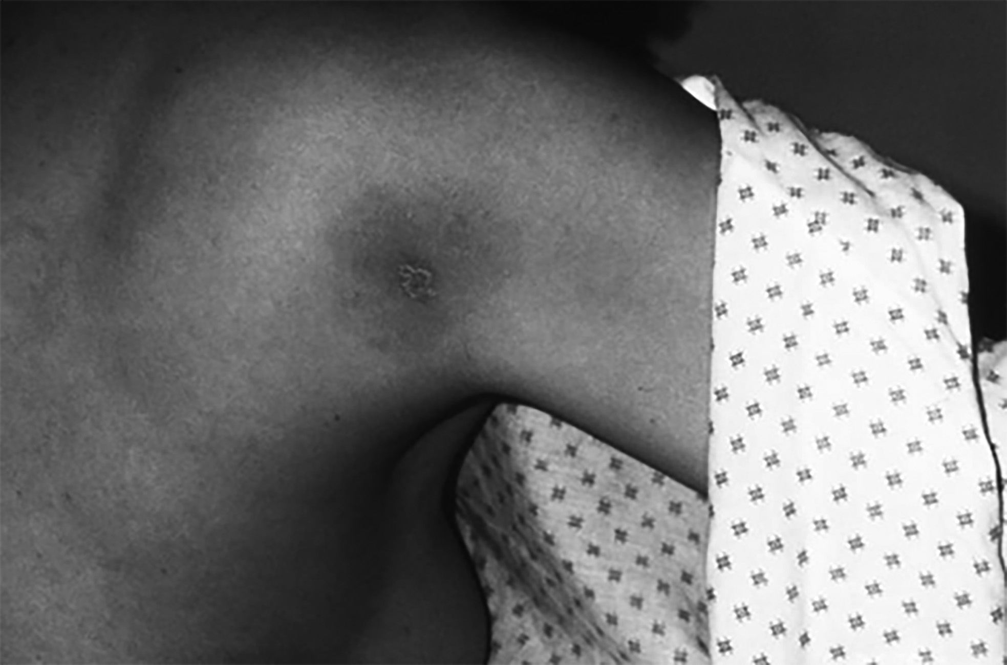 Erythema migrans rash