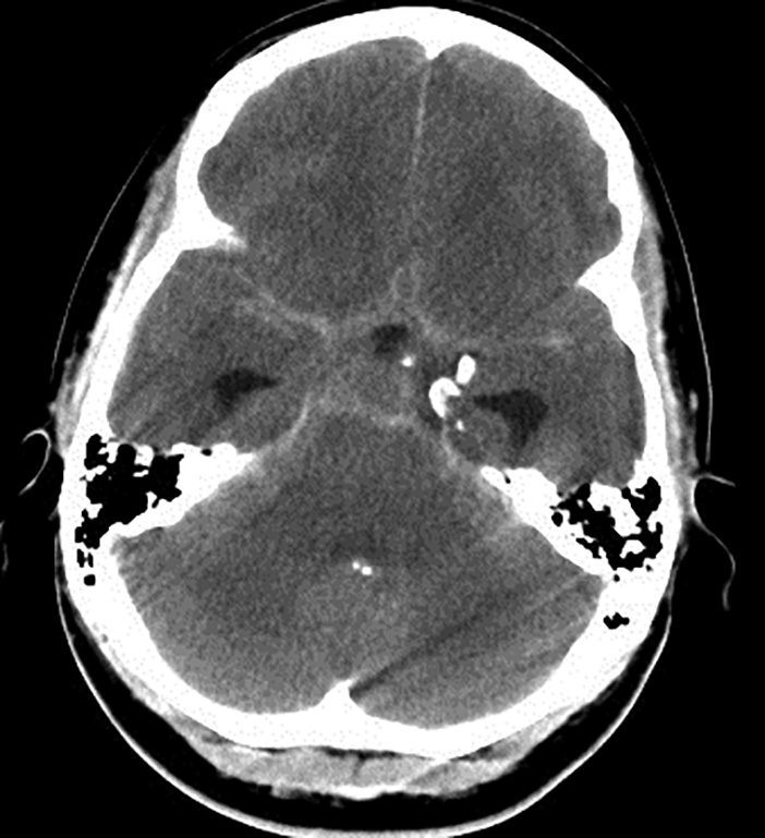 Subarachnoid hemorrhage