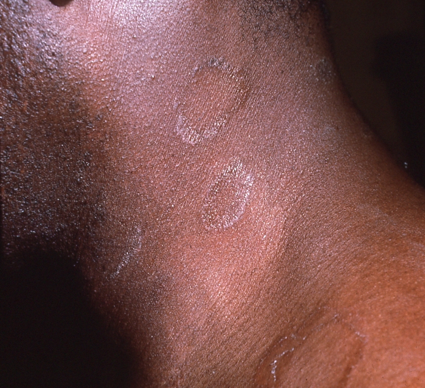 Pityriasis rosea