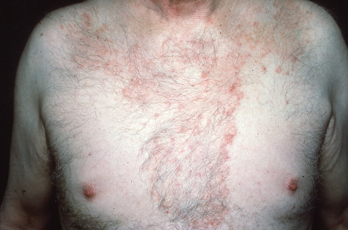 Seborrheic dermatitis