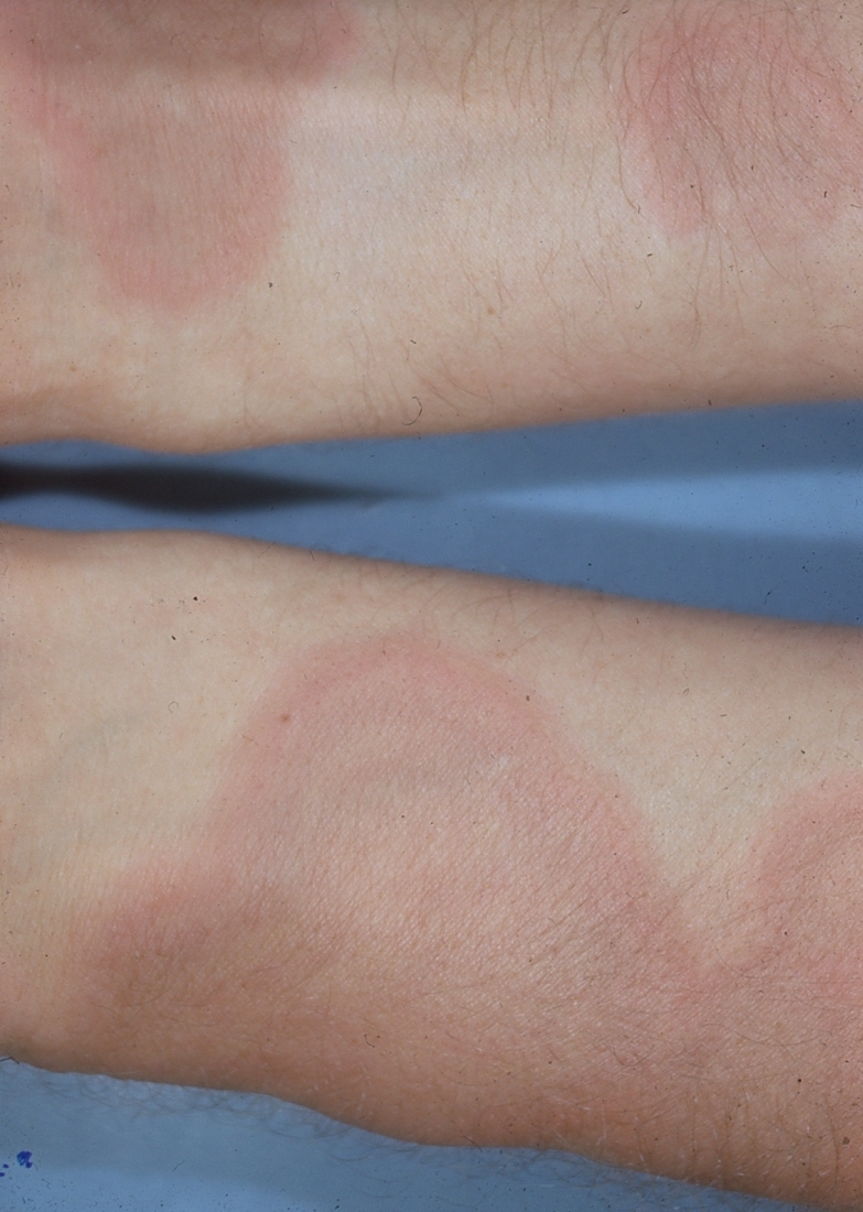 Erythema multiforme